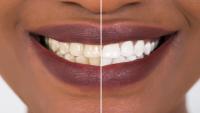 before and after comparison of tooth whitening procedure, woman smiling to show change in color from yellow to white teeth